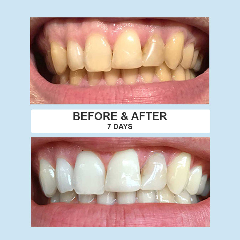 SmilePro Teeth Whitening Strips