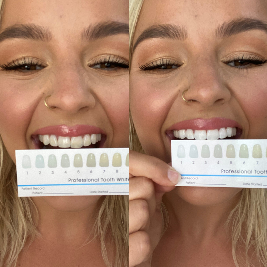 SmilePro Advanced Teeth Whitening Kit